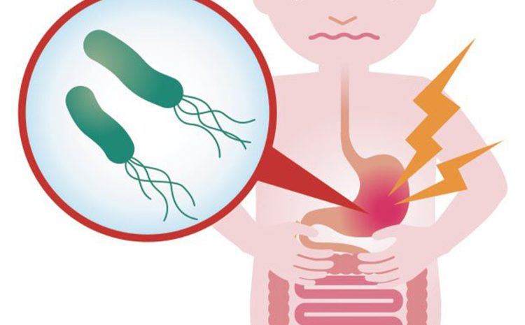 Urea Breath Test – determinare infezione da Helicobacter pylori